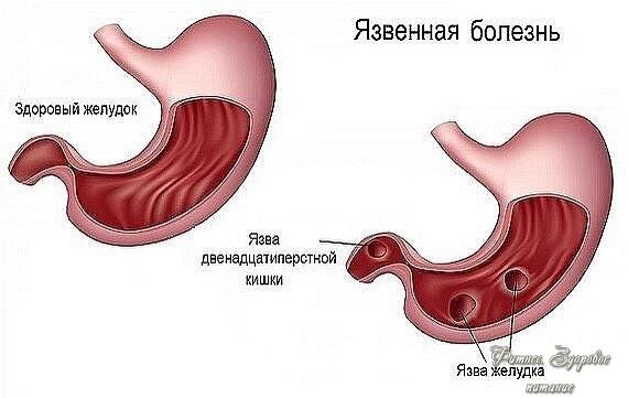 Язвa жeлудкa.