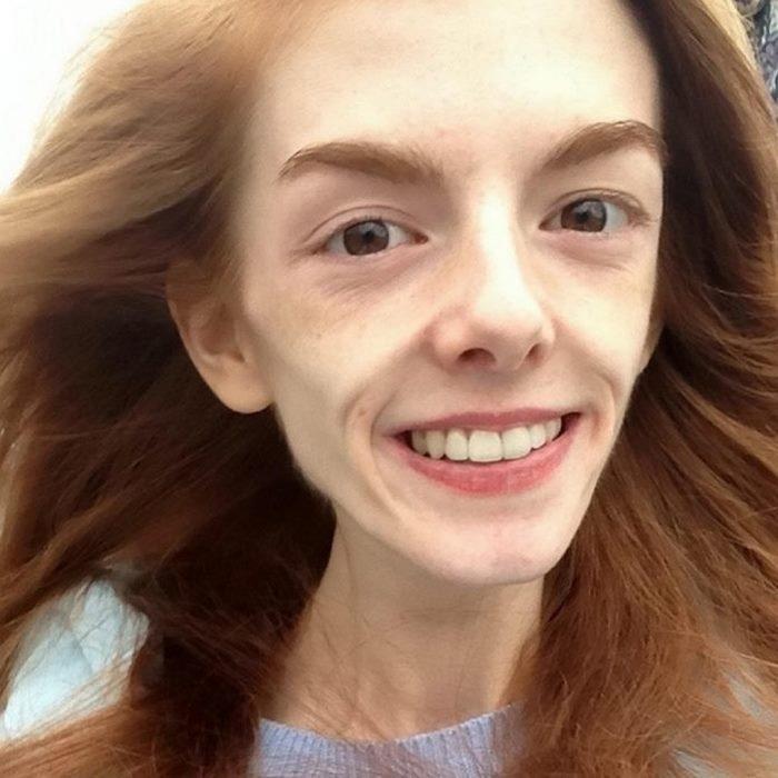 uGpWO0bfbIc - 21-летняя Анна Уиндли весила всего 29 кг, но смогла победить анорексию.