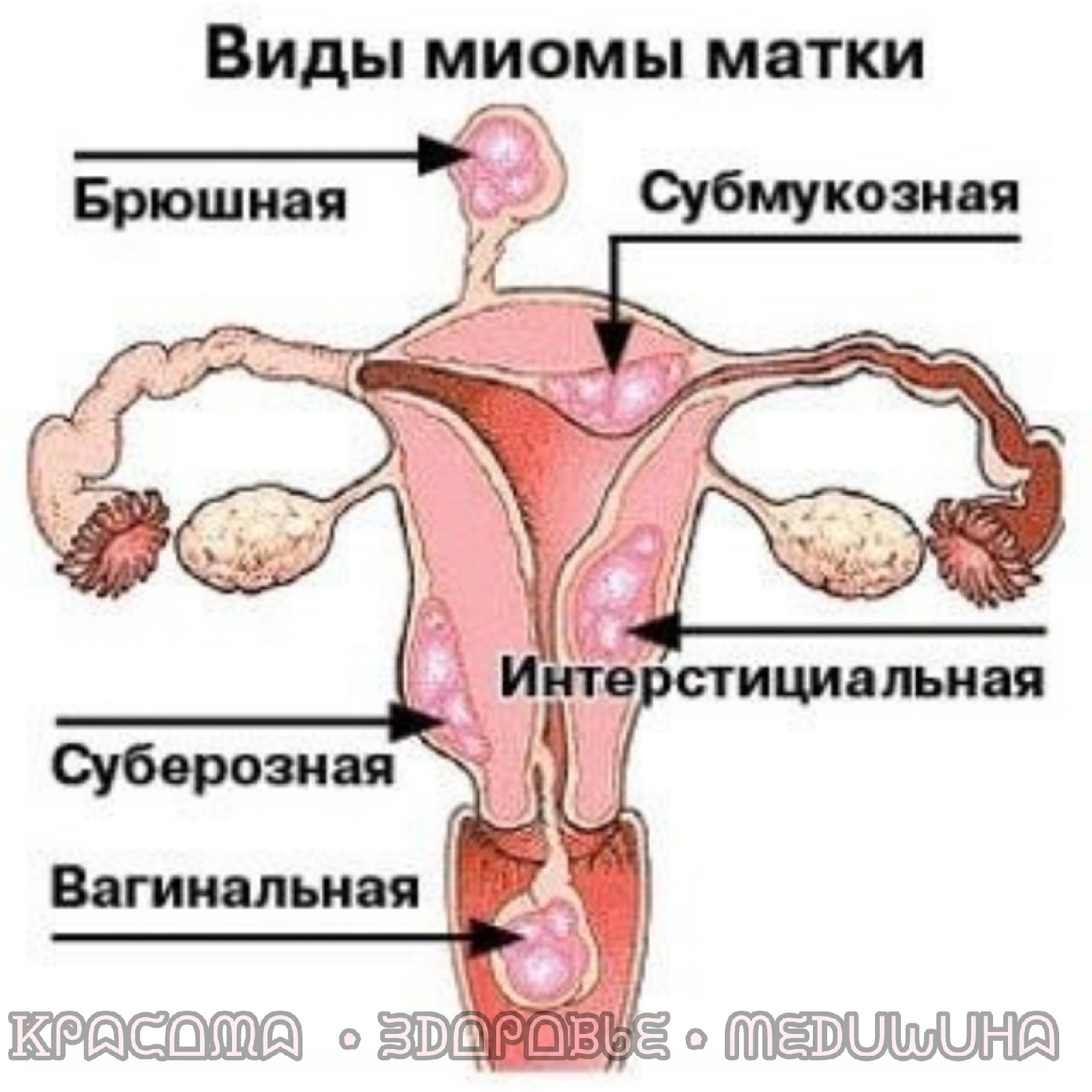 HJW 1eXLkiA - Миома матки-доброкачественное новообразование, состоящее из ткани матки.