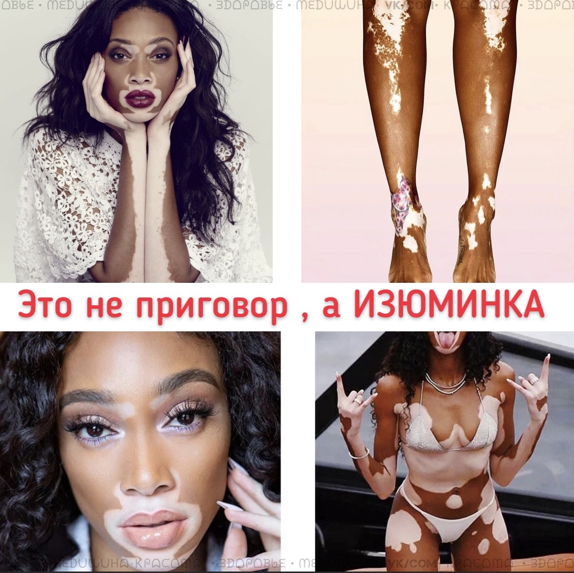 nDbm4gKTRrE - Аутоиммунное заболевание-которое выглядит, как изюминка.