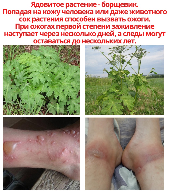 Казалось бы, что растение с цветущими зонтиками безобидно, но на самом деле борщевик может оказать негативное влияние на кожу человека. mBThWXekYMog5U95n9BGVE6yxp9pUIOwMNGaWTpJLq2RHiiSmoGmhTRlG08kEG6C2u2qDNFxLcVd64oesj1SXSL - Казалось бы, что растение с цветущими зонтиками безобидно, но на самом деле борщевик может оказать негативное влияние на кожу человека.