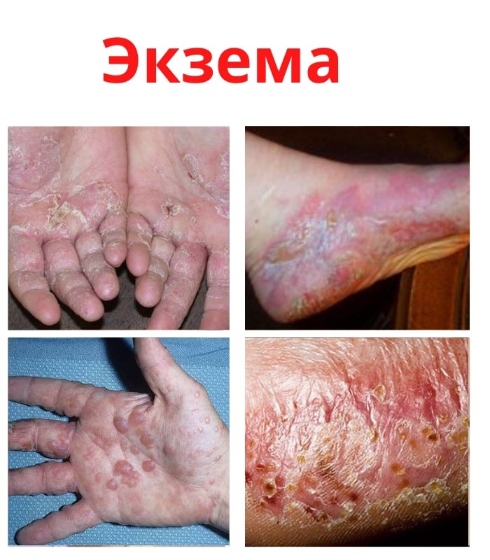 4rWjtB6WFlpMEJEG7XYOb2EpTGR1e2w7ETEUA1PIYwKAxP2ofqahGUKr3lBWvkRqpSICWjPdM7nM3ce4sBowBpD0 - Экземой является кожное заболевание.
