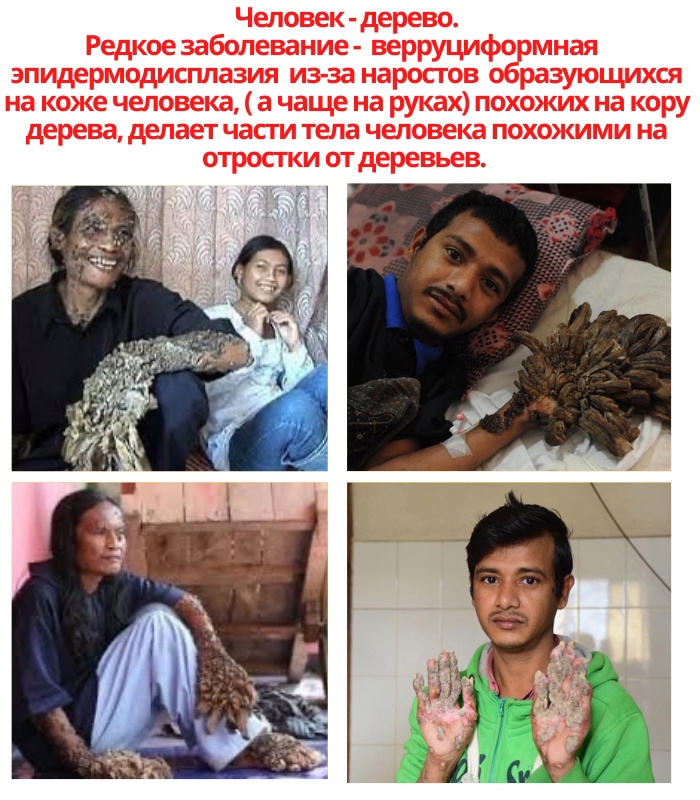 5nW5F0FVnl9DZV9I825BwPTcI5SrNvDv7Whgfo3GMyOBx7Q0713BGn1DapkOYArVozAoNjS5NyC79V7dkCInWDKX - «Болезнь древесного человека».