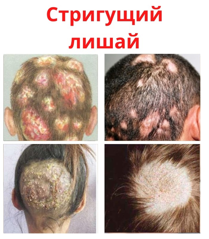 CJaPHb7tY bvyB6 uSkwMURDtmtjPtRWlXRhQFlY YmTjtnC4PDA7etULVqqXU93MKVxeaJotnTCSVuO8KzczKS  - Стригущий лишай является заболеванием, которое проявляется в виде кожной сыпи, вызывающее зуд и выпадение волос.