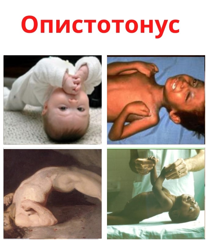 XAiKcGraW cWby6SMp6nttb7pzRXwSHucVps8 vT0HQuUkeFoupHa08uS sHj1DyEdiF5qUKvHRUNbqZqkSO9CTH - Опистотонус – это резкое сокращение мышц спины и шеи.