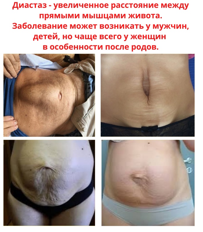 c3s40yG0AH7ztFQo254664ZCVhAyRj wE404qNm0LnEn 85z00KphbNkFKiEU 9oR6bcmsBIwekQrndRmHZZTru8 - Выпячивание живота, это не единственная проблема диастаза.