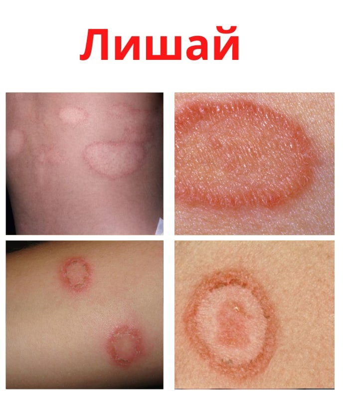 n0yiKCqdPJMCcQy0HeYy1 2pFEFeDuM5ygWJWx5LvqZpP6dFEZQLx4K5TX0fCFSPp1UXp8NvPTxBIz7j 7 Jai5y - Лишай – это кожное заболевание вызывающее зуд.