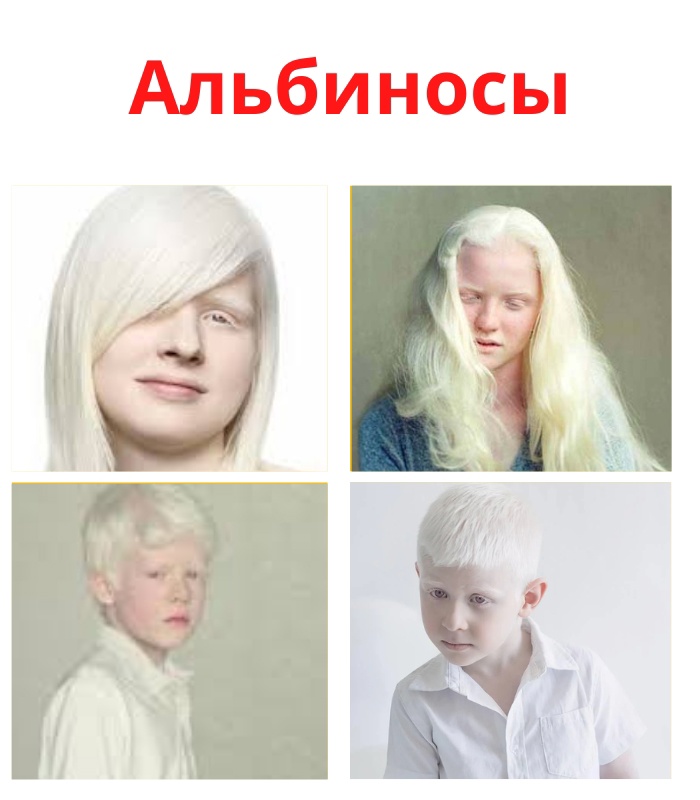 5p7U319s8qZjGLmuodxgZtJ LSsy 0PvnkKDoPhDdii27Z5BeHjovCk0zPqwE6jQ kLdNh scrVm5JEsp CI SBc - Альбиносы – это люди с редко встречающимся генетическим заболеванием.