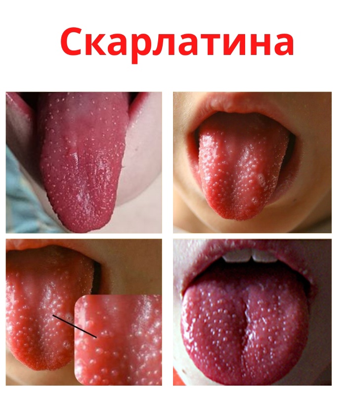 DYb4QneIGHUxcURad66TbnOsGji34DFGDtpGZjbYEejE5hlw2r7TeAww D9J88xQFno1lCue4bR3mP FegMg6gyI - Скарлатиной является инфекционное заболевание верхних дыхательных путей.
