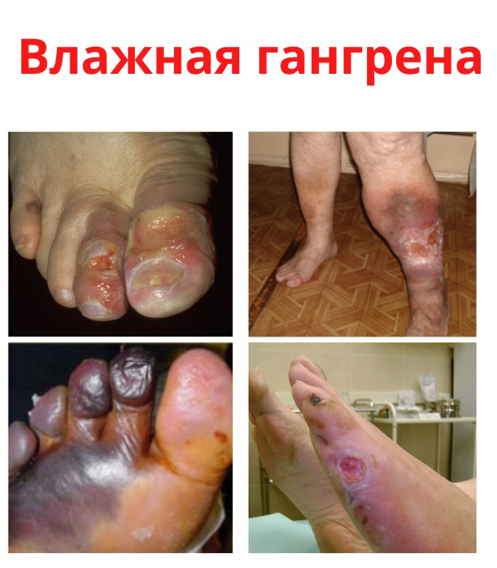 IUttoILJTLs1Yak1XSoK0yreCA3BO3RNrwQLzKpB8QjYc39AatOAfNxbglMzVxcbLlwpcR7b1rQ oalkzDWPey2u - Влажная гангрена возникает в случае нарушения кровообращения.