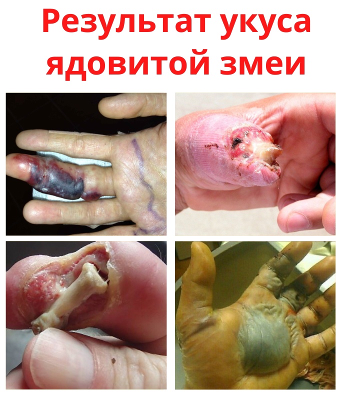 XnLsUGt5nbPP6 Ar xDjH075vGoLhMO3jtmF8C79TZIB4X3Q7JToDkKTJup2qZP72mMmrNR1NdB1EdGUH6Ud9idN - После укуса ядовитой змеи, человек чувствует сильную боль, затем образуется отек и кровоизлияние.