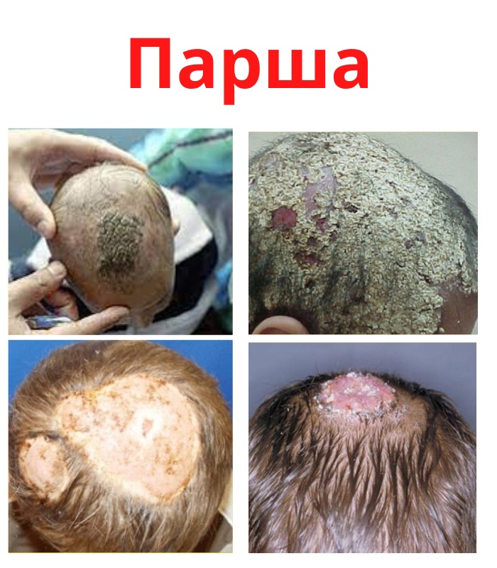 Парша является грибковым заболеванием. 2CIlVbEWUteOklwvqFTFPgpyysTw6P1KuUk8GzE2YiUpdV hVpwTov 9n68FF06a HAg5xkh SkJD7rI00wLMf4X - Парша является грибковым заболеванием.