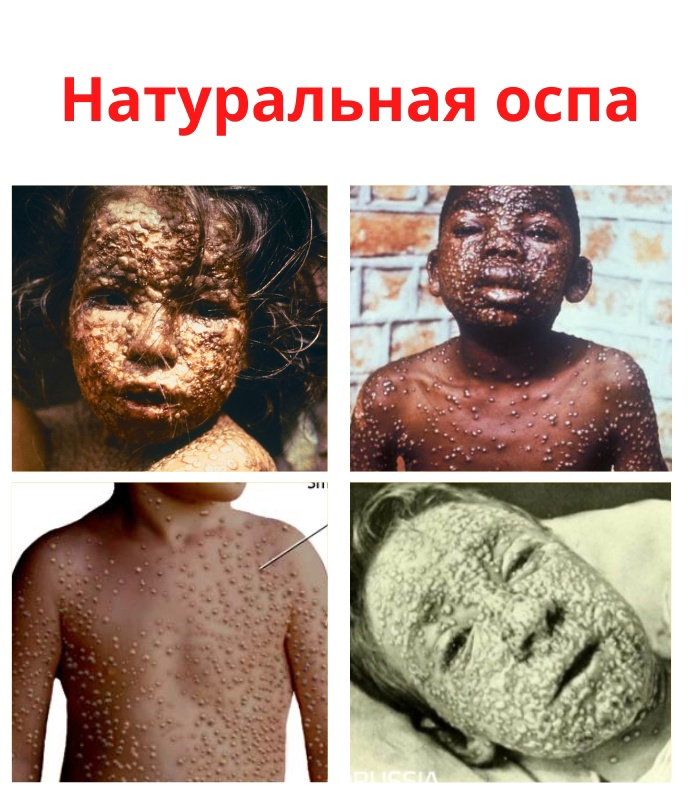 2klm p jRS5 1usegRh1lorT2RxOa92fWv6QEcHPHFNkD1I6pVyyxAhvTAkKHNJDOaabROo08IckwdUJE0bZL H  - Натуральная оспа (черная оспа) является высокозаразной вирусной инфекцией, которая передается от уже зараженного человека.