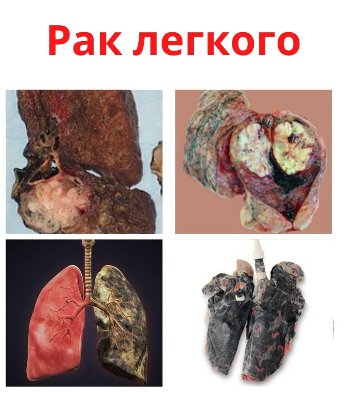 AXRXZrh614L9t9N TSU4WADme510dN05oryB0MMMsAypvu4SgqGt q19cwviyAhLFr CS5krJZKl45Y0GqZovxme - Раком легкого является злокачественное новообразование.