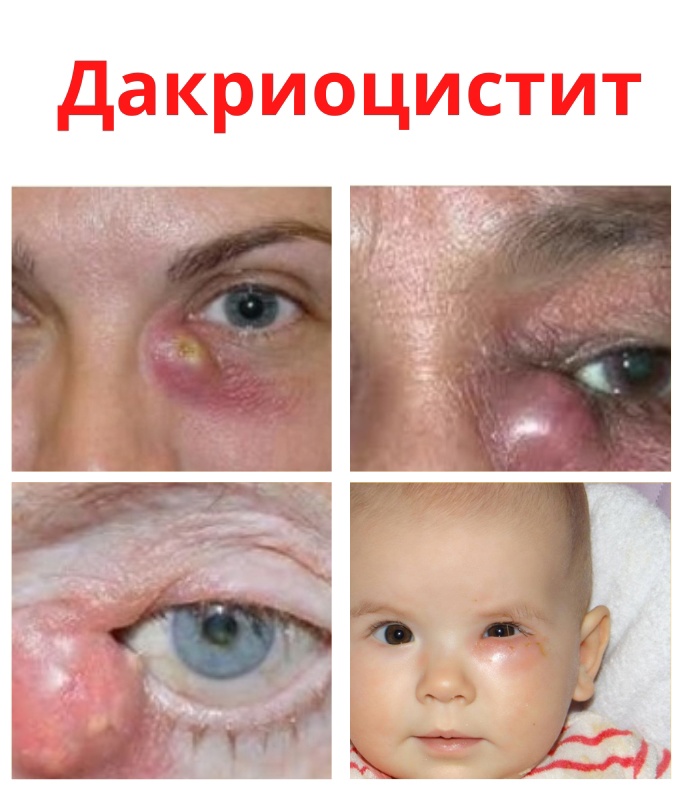 BC  txDcjAO mlAjlFy9iLOXYCZiM7MNLz JNYWrDu1EyUu0xAEap08tXdqlSzSagTACf1aivCxE1VAHnHiWkDn - Дакриоцистит является инфицированным воспалением слезного мешка.