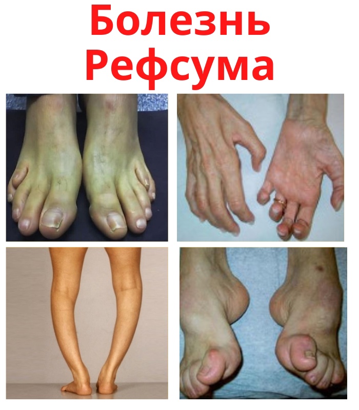 LNtK1unXT   1Bfe0dPfasbGIBpJawF19VKBygxN2aF9MyGtigzYocWqgnEYGWU313PH0 O6EcfBQtLa6cFlWYZP - Болезнь Рефсума является довольно редким наследственным заболеванием.