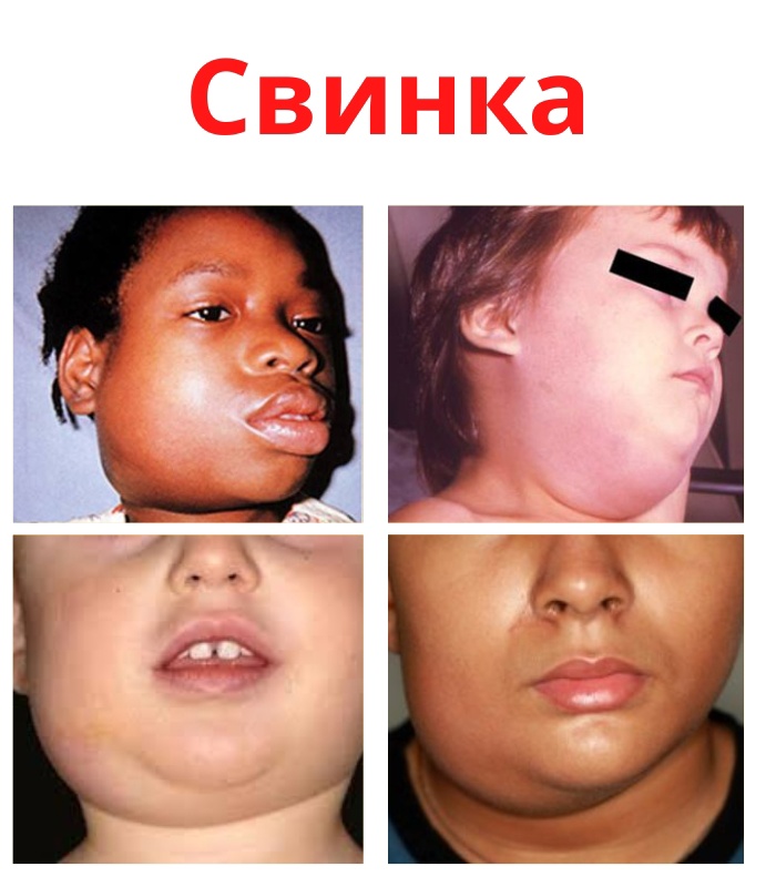 Rx8Ns7Du M3K5l5B4OBwuKUKI1MpgV9bJgBwPDCsZ1MgzXdM8gyFFJDTaphrfZNp3TUmjFhTqGsqgt6JlCLDv0p8 - Эпидемический паротит (свинка) является инфекционным заболеванием вызванный вирусом.