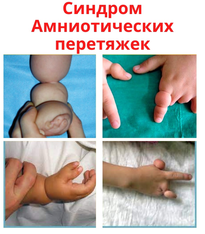 gLH9upEArccCmhzony9kXsdQ4rPJ rkNyWPJYjMrtsBzWL DvzFtBMR5ZpHU7rVuTOXmVR3W yPqG FVrQZ AXD7 - Синдром амниотических перетяжек – это аномалия, при которой в плодном пузыре образуются волокнистые нити, которые опутывают пуповину или плод, что вызывает у ребенка различные патологии.