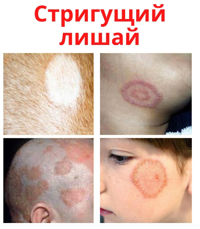 Стригущий лишай является высокозаразным, инфекционным грибковым поражением кожи, а так же ногтей и волос. gr9cuOvizcxHfryNuf1XowA5e7CLbSaExXulvvMqDb7SYsATCV3u23I8AXa4TlXjViw36rjya8G0JnfaXyBKma1P - Стригущий лишай является высокозаразным, инфекционным грибковым поражением кожи, а так же ногтей и волос.