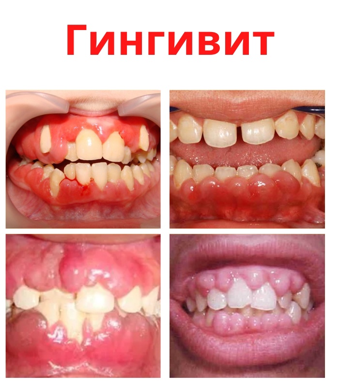 x8VTEyEBpTU Uaj3tja3 IgvMajyKiLqLVk3 ArCfwH4w pfNbqzisO15B5zUAOUuykSm9lODnCeBkVLiQLQKgKe - Гингивит является воспалением десен, с отеком и кровотечением.