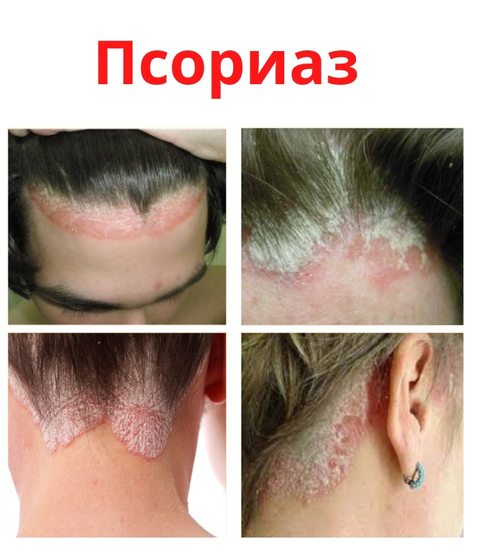 Псориаз является хроническим заболеванием. xsnDLDv1nYLUM CBUWtVUAf GaZ 1WJidQra0pGREzT30XRUwxKpPl2Qo8vVyaGR2VswtHgZdvaVUFvkrG8XEbiK - Псориаз является хроническим заболеванием.