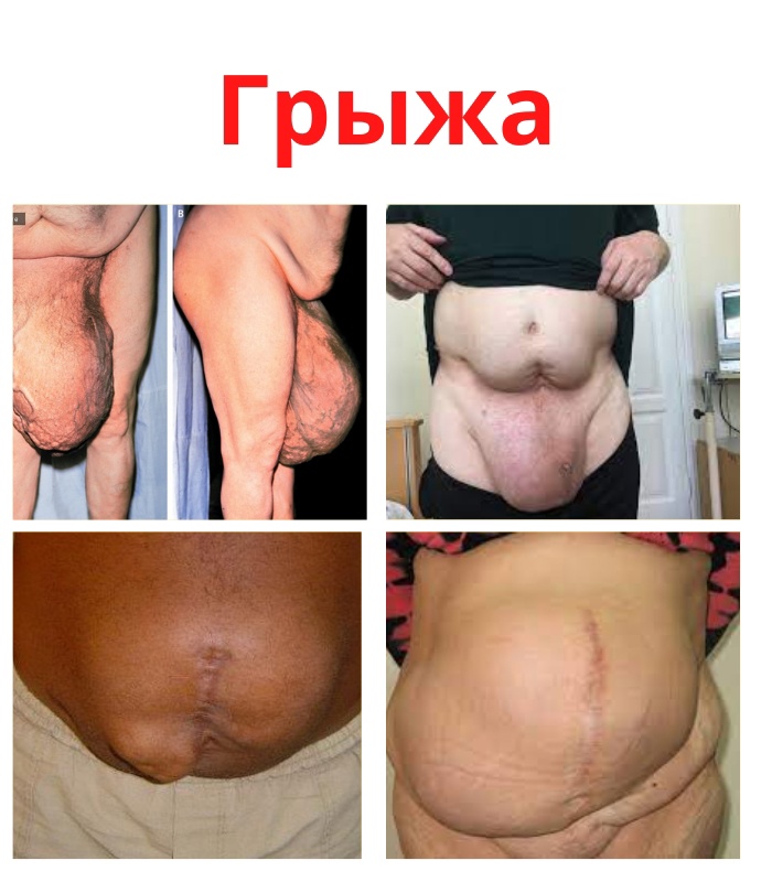 2QqkT680S6aQtSvcPWGCBqSpllyDwJRVmvhLGk8UEZEHJh07WNgHshDwDq8rgs8w6RgoHfQke6hpA1nFBm95ILce - Грыжа – это выпячивание живота, а точнее внутренних органов.