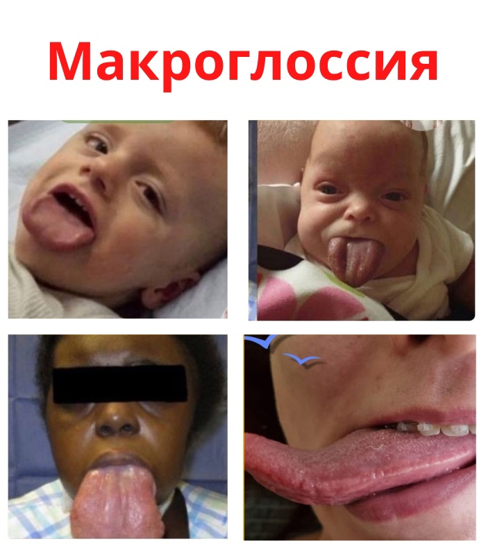 JNSgXfGHaHRlpNTvsEQ s6cLDNDfqlZHd0LybOPHNy1n2f01ZLVfLFsyj11phI3COjmajyWyKt0dRUUv90CaoY72 - Макроглоссия является редким заболеванием, характеризующимся тем, что заболевшие имеют слишком большой язык.