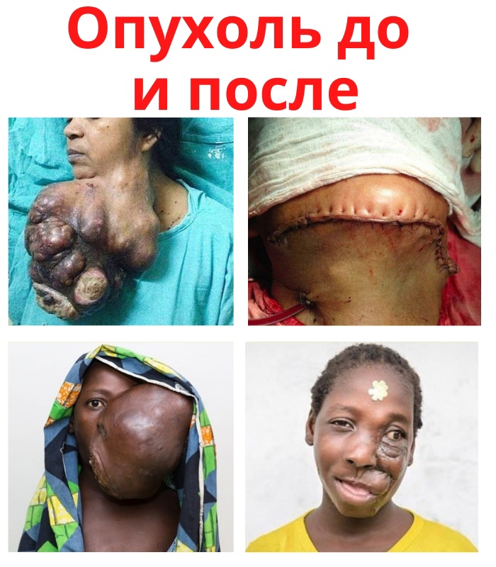 OvdoRuW zZNI9Sb5dwSlY1FL8c0ARWEczfA0X73Jhzi0jmFxwl3U0NRJrc4ctoQDysVXtu7rAi9oVUtlvsjkkulm - Огромная опухоль выросла на лице этих женщин по причинам до конца еще неизученным.