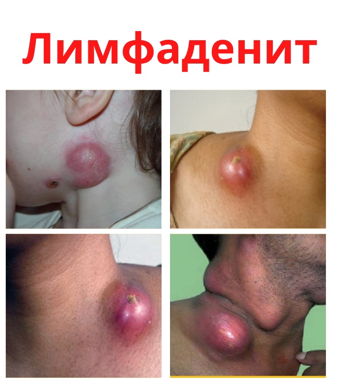 hJPEd5Ep7gzPgrgpUaPZHmQKO JYaP3IwusTqcf3Hgnk0UC4ZZnR2vqggLx78PjSghYBApO1jENj8bLfedT ZKp6 - Лимфаденит является воспалением лимфоузлов.