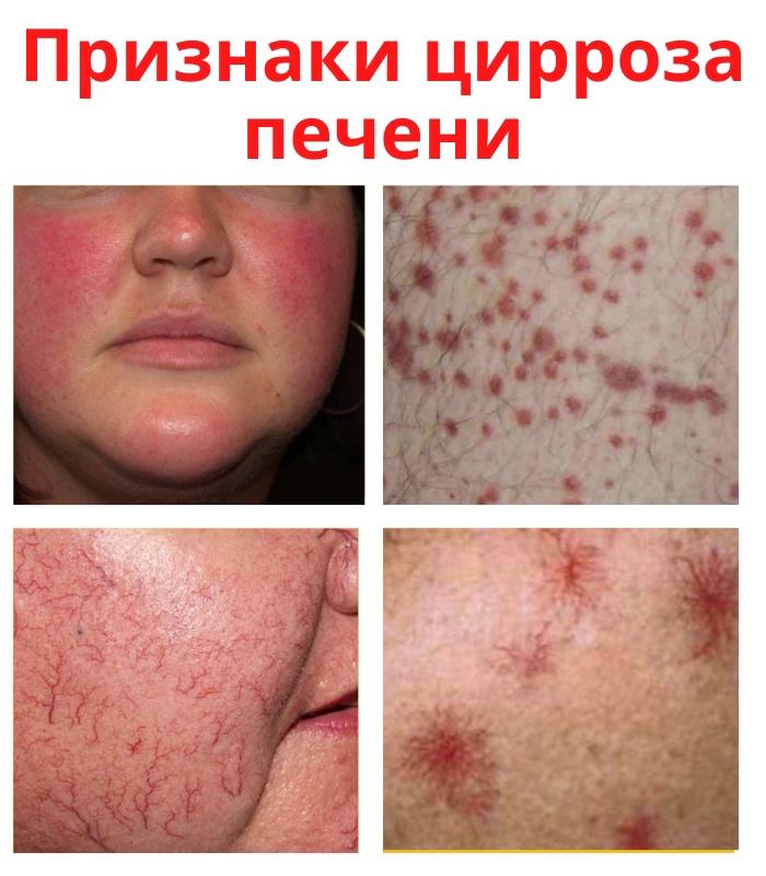 qS0D6GQe9W6GBebNri3VRiZEGyjOEXmbXBZlSJZilPp0tpMw4cLXZbv6ReDDQx5LE6Ihpb2EYLP9JBeEDQ8hndjk - Симптомы проявления цирроза печени: