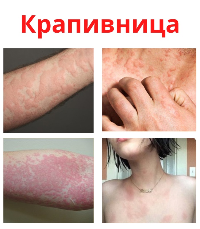 0NLulc4ZNYaDPo47 o0XdEpy kOX7VD IzAcIGhum6DyOFVR0hdWY3ntj52RE UTyMHkO swTkQgqVAcuWmo6bLy - Крапивница (дерматоз) является аллергической реакцией кожи, на какие либо раздражители.