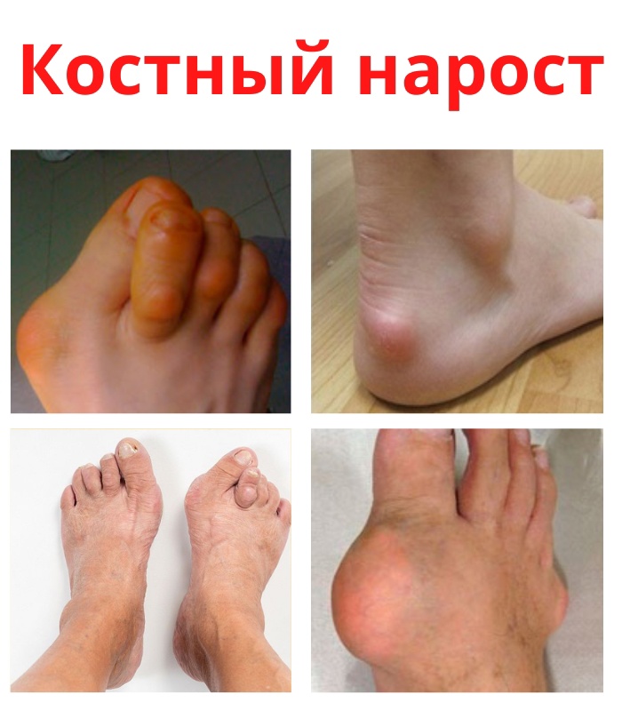 2nnWuMJx 9SjUxzDFMGulsPRdPbQ6DZLmm8zcuftxKoa9oAgVTjDdDCa19QaT6AzDp5yT8FEHDDEI9b5lc2MZ8Gb - Костный нарост (остеофит) является наростом, образовавшимся на поверхности сустава.