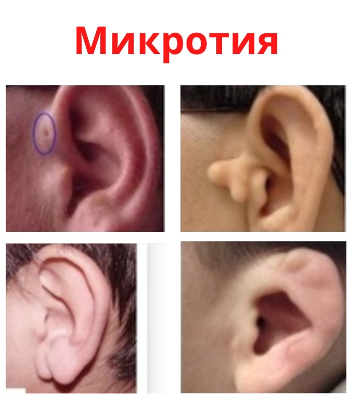 JNo02b bQ1PGmO31UbghQeRHwfYYO8 XzC4C7KlZnZfeN0AHWH3TE9FkzaEzPcDpoUazfgx5qCKHQzcqP9hEx8S1 - Микротия – это врожденное недоразвитие ушной раковины или же полное ее отсутствие, что является - аномалией.