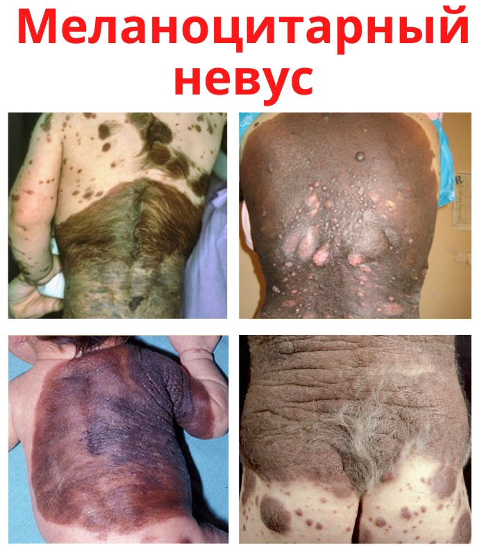 Меланоцитарный невус является доброкачественным образованием. blzhNR yLehssP0v r17raJ5 4J5rhqjs6e1vwwrmxlTwWrxr5C1z4vIhW6d4taYHYFrefRFjuaqq4krljtR1IA9 - Меланоцитарный невус является доброкачественным образованием.