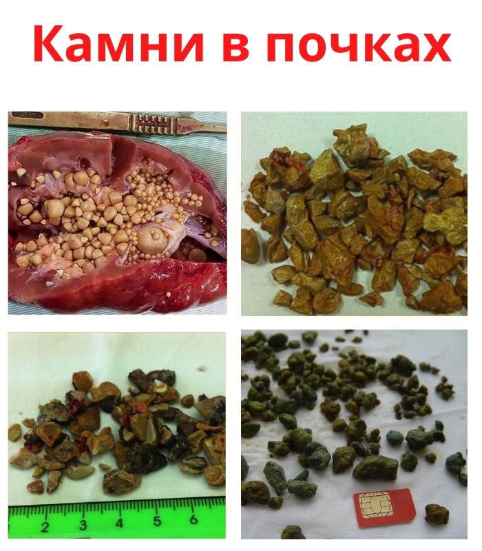 x0uS8O0FZ8D1XvMJROkSLtWerfk4T8ryXaEC6WO XRY0vZhVjjFnGG xRLmuGW0W xrB75lDEXkLH1r5VGP8WVcw - Отложения из минералов и солей образовавшиеся внутри почек называют камнями.