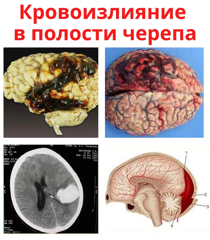 Кровоизлияние в полости черепа является серьезной патологией. y24ZrQM5s1OBgJ56zpJoJn2y8F z73F6AlNFY DbgRJQTlDtwsOb46ortMNmygVQTf2ZH23ywBMqtUNY5sUaabN7 - Кровоизлияние в полости черепа является серьезной патологией.