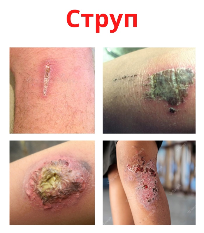 3OGkSBQL nw - Струп представляет собой твердую, плотную корочку, которая образовалась в результате высыхания крови на ране.