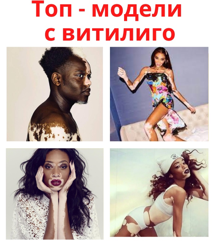 KoCRAMYmniE - Витилиго является заболеванием, при котором в связи с потерей кожи естественной пигментации из-за разрушения меланина, на теле образуются светлые участки кожи.