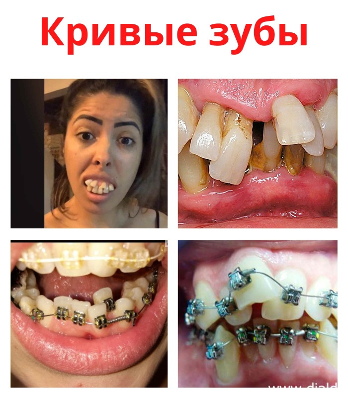 Основными причинами искривления зубного ряда или образования скученности зубов является детская привычка сосать палец или слишком длительный период использования пустышки, так же причиной искривления может быть медленное развитие челюстной кости, раннее удаление молочных зубов, а так же полученные травмы. RLTtWl7YFO8 - Основными причинами искривления зубного ряда или образования скученности зубов является детская привычка сосать палец или слишком длительный период использования пустышки, так же причиной искривления может быть медленное развитие челюстной кости, раннее удаление молочных зубов, а так же полученные травмы.