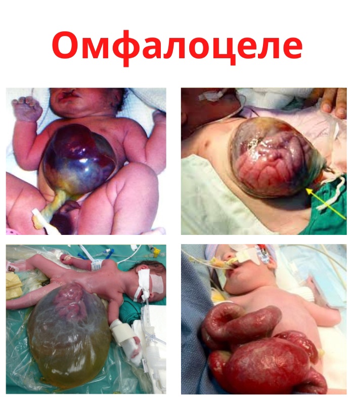 e9r l93w6GKI4KfNWKENkUPOI8y37oa4LLRio2ltqbd190nF q780TIiul63WFBQIb3gpDinN9b32K4cduNvPA8e - Омфалоцеле является аномальным развитием, при котором имеется дефект передней брюшной стенки в области пупка.