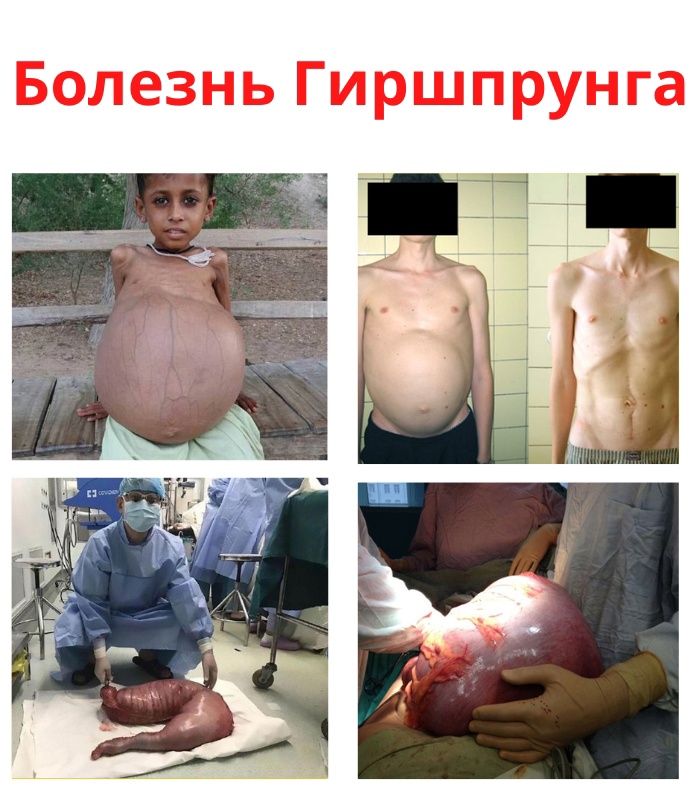 yo5MA43RpuWKp9qfoC3SMYEucYTjEIPSlUNr4lymHp7CVCQ 8Qt3pIqlX27N1lJN4NG3OhgmjyPw7kHu5FBoNaTt - Заболевание выражается врожденной аномалией кишечника в нижней его части, что вызывает запоры и вздутие живота.