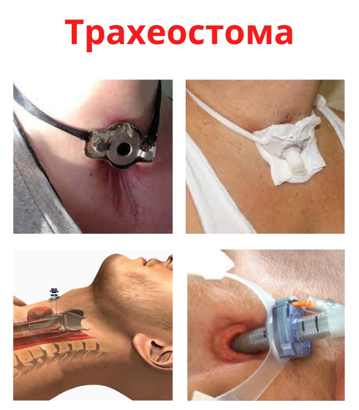 9sqI4tXXzcA - Трахеостома является хирургической операцией образования временного или стойкого соустья полости трахеи с окружающей средой (свищ).