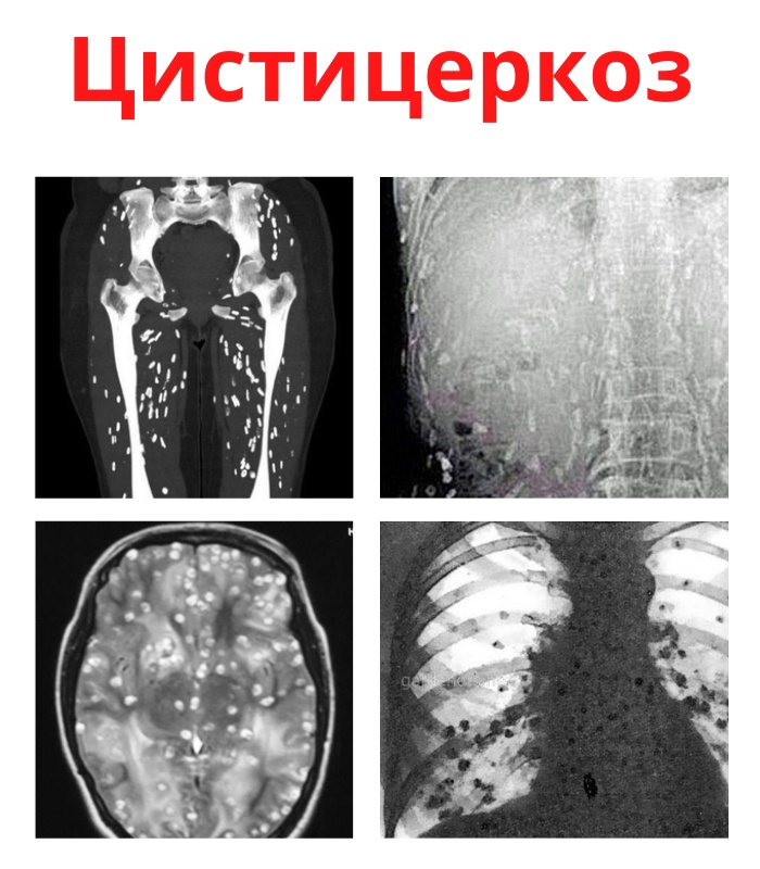 OQ0m4awKMao - Цистоцеркоз является поражением мышц гельминтами из группы цестодозов, характеризующийся в зависимости от локализации паразита поражением кожи, подкожной клетчатки, мышц, головного и спинного мозга, глаз, внутренних органов, костей.