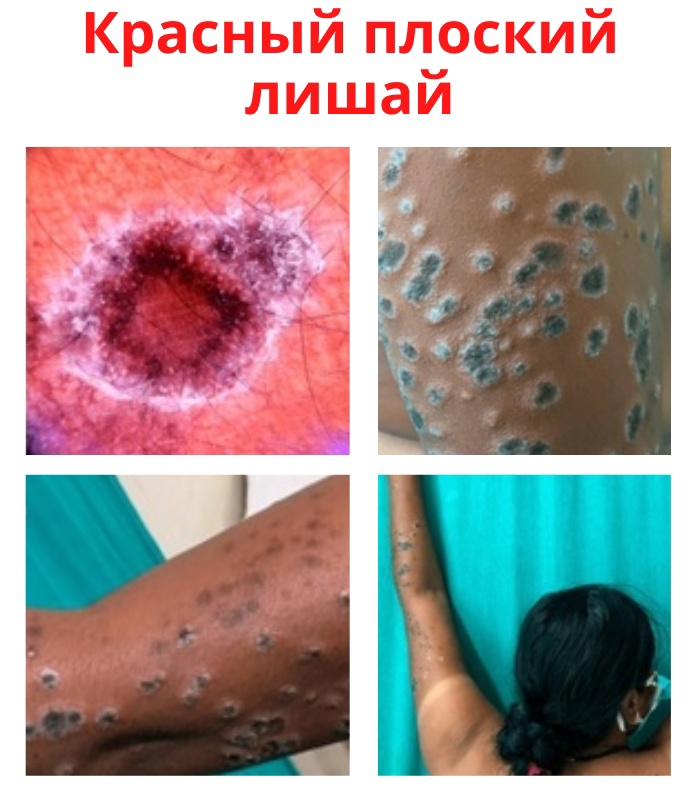 UeIsyo3rpEM - Клинический случай актинического красного плоского лишая – воспалительный дерматоз с многообразными клиническими проявлениями, с вовлечением в процесс кожи, ее придатков (волосы, ногти) и слизистых оболочек.