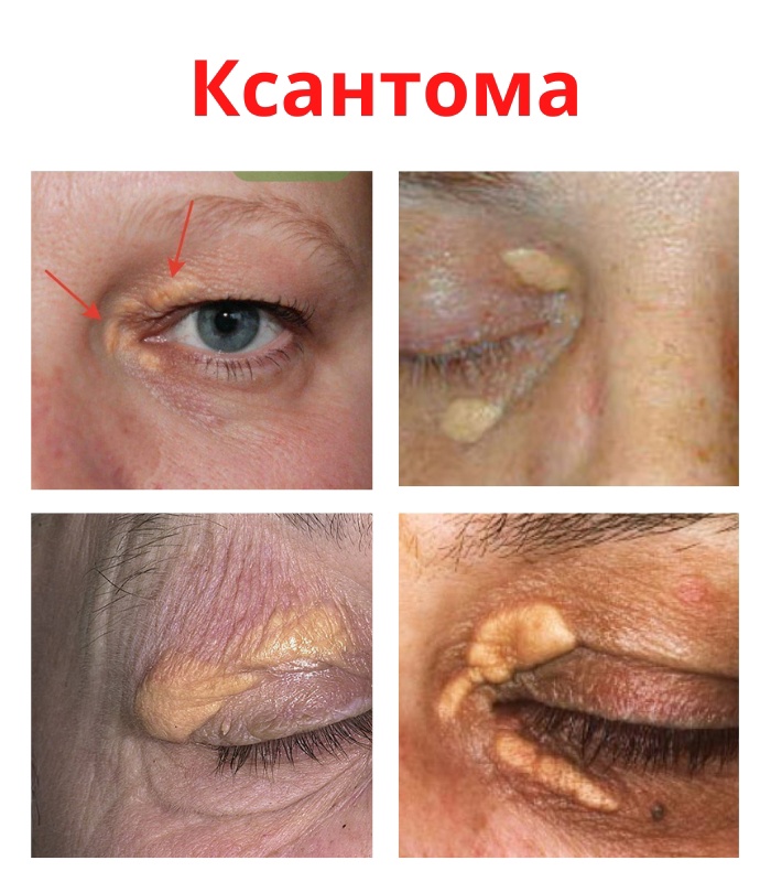 Выпуклые пятна на коже. VMh 4WeQtvA - Выпуклые пятна на коже.