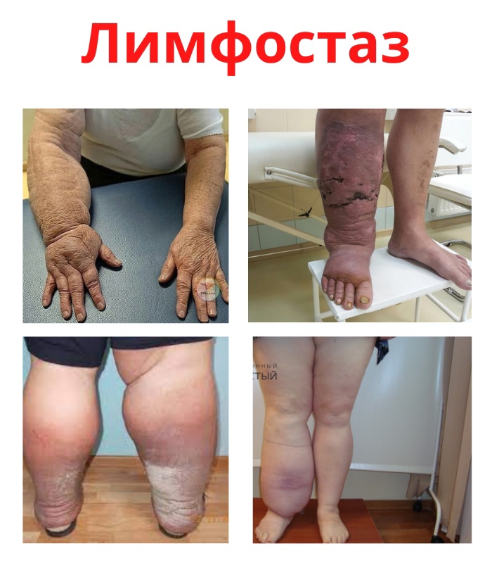 gbGq0K8jl64 - Лимфостаз является патологией лимфатической системы.