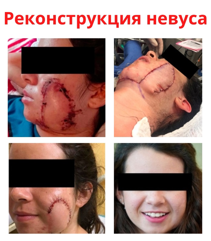 n7D TIP0BMk - Реконструкция гигантского врожденного меланоцитарного невуса.
