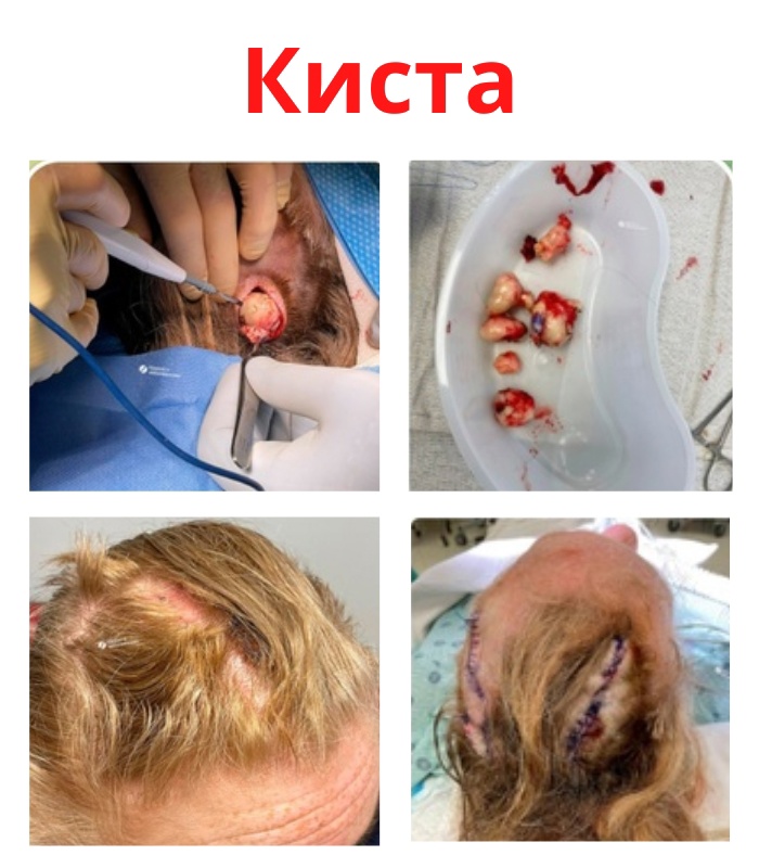 t Ky3oVPhd8 - Удаление пиларной кисты на голове.
