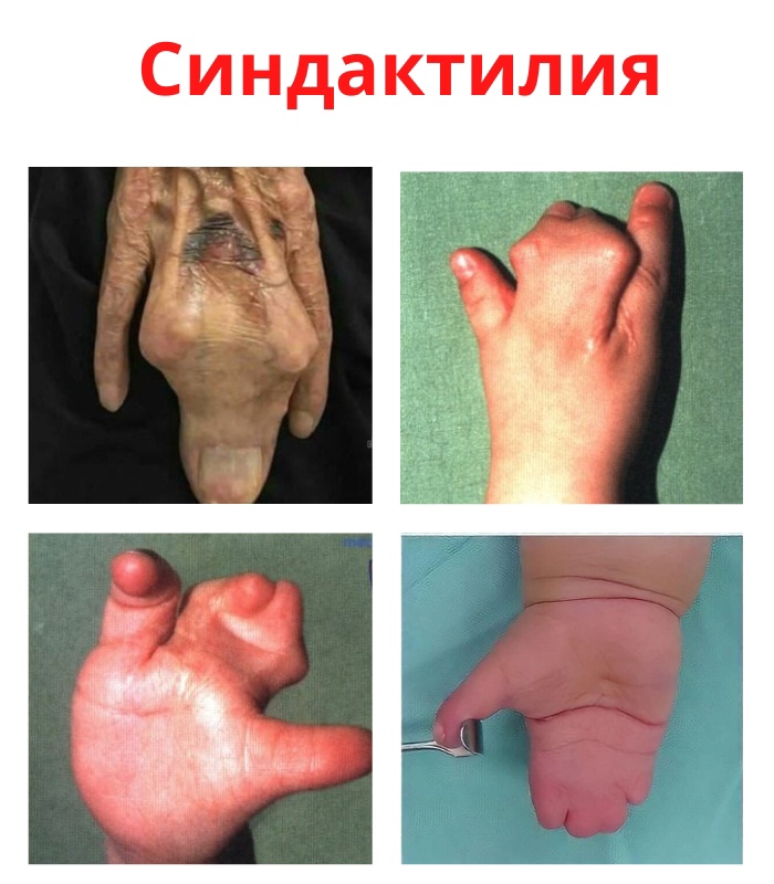 tpaK3kTjOrs - Синдактилией является врожденный порок развития конечностей.