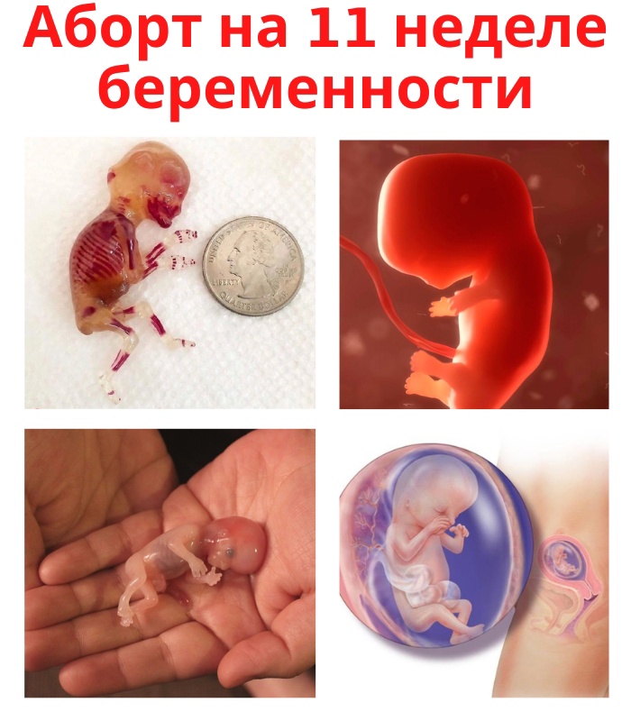 MCp4RtDGfbo - Так выглядит ребенок после аборта на 11 недели беременности.